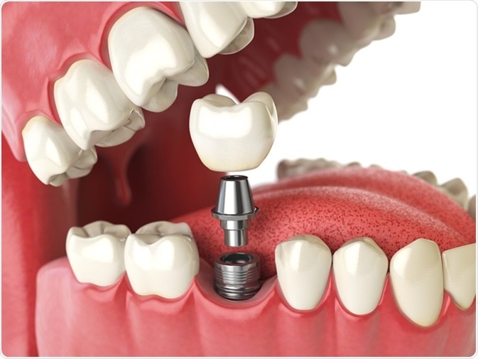 برنامه ریزی درمانی برای ایمپلنت دندان (2)